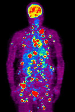 PET scan showing widespread metastasis